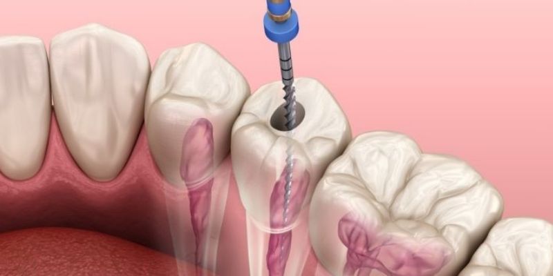 How Do You Know if You Need a Root Canal Treatment