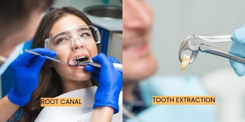 root-canal-vs-tooth-extraction-which-option-is-right-for-you