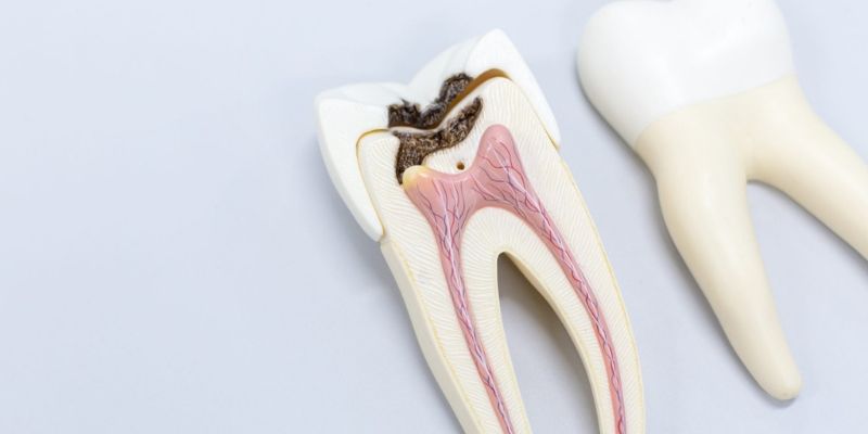 Root Canal Treatment
