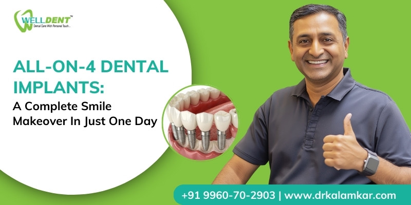 All-On-4 Dental Implants: A Complete Smile Makeover In Just One Day