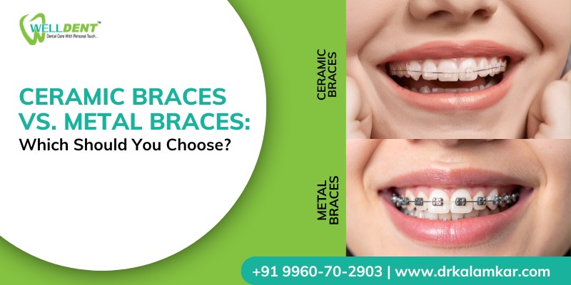 Ceramic Braces vs. Metal Braces: Which Should You Choose?
