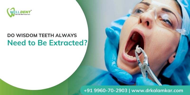wisdom tooth removal in sakkardara