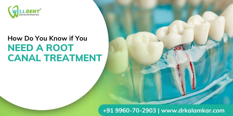 How Do You Know if You Need a Root Canal Treatment
