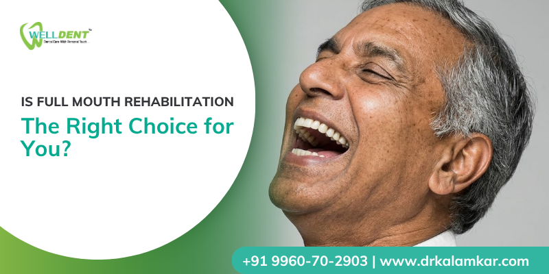 Full mouth rehabilitation treatment