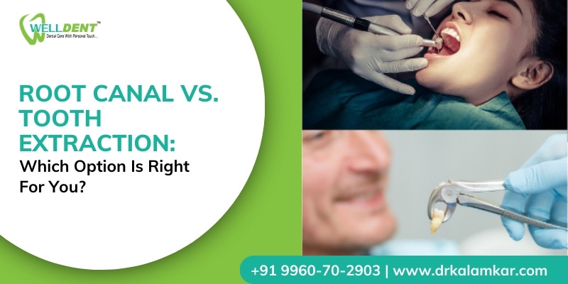 Root Canal Vs. Tooth Extraction: Which Option is Right for You?