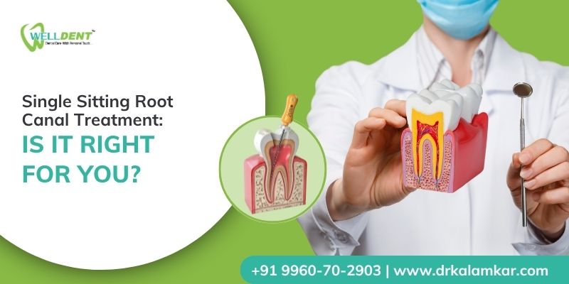Single-Sitting Root Canal Treatment: Is It Right for You?