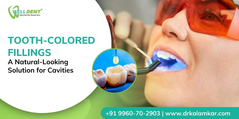 Tooth-Colored Fillings: A Natural-Looking Solution for Cavities