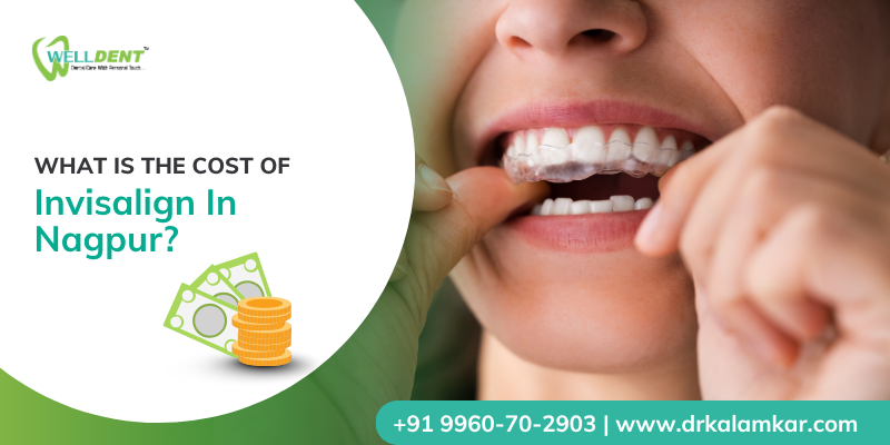 What is the Cost of Invisalign in Nagpur?